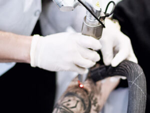 Tattoo Removal
